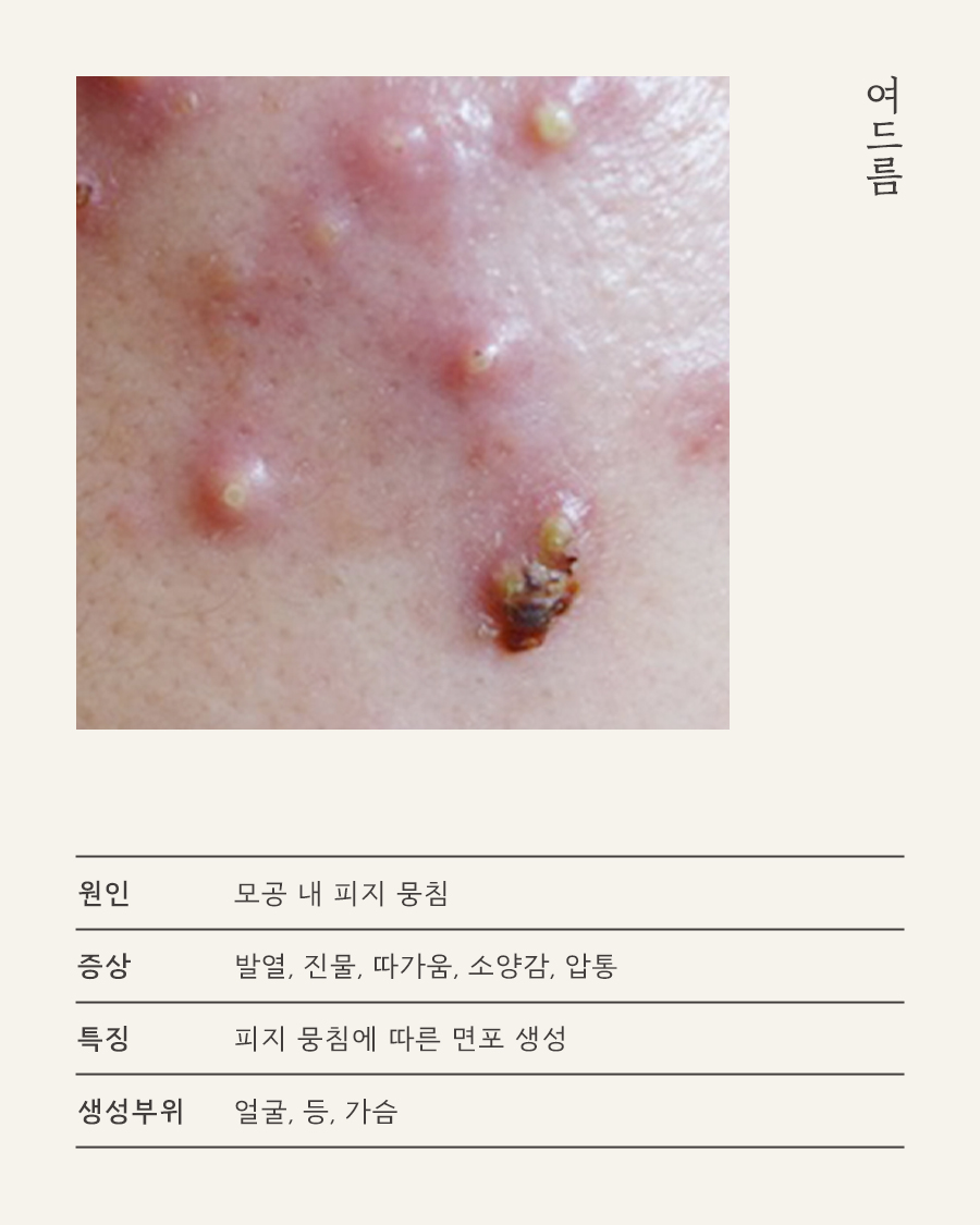 [수원점] 수원지루피부염 화장이나 선크림을 사용해도 되나요? - 해율한의원