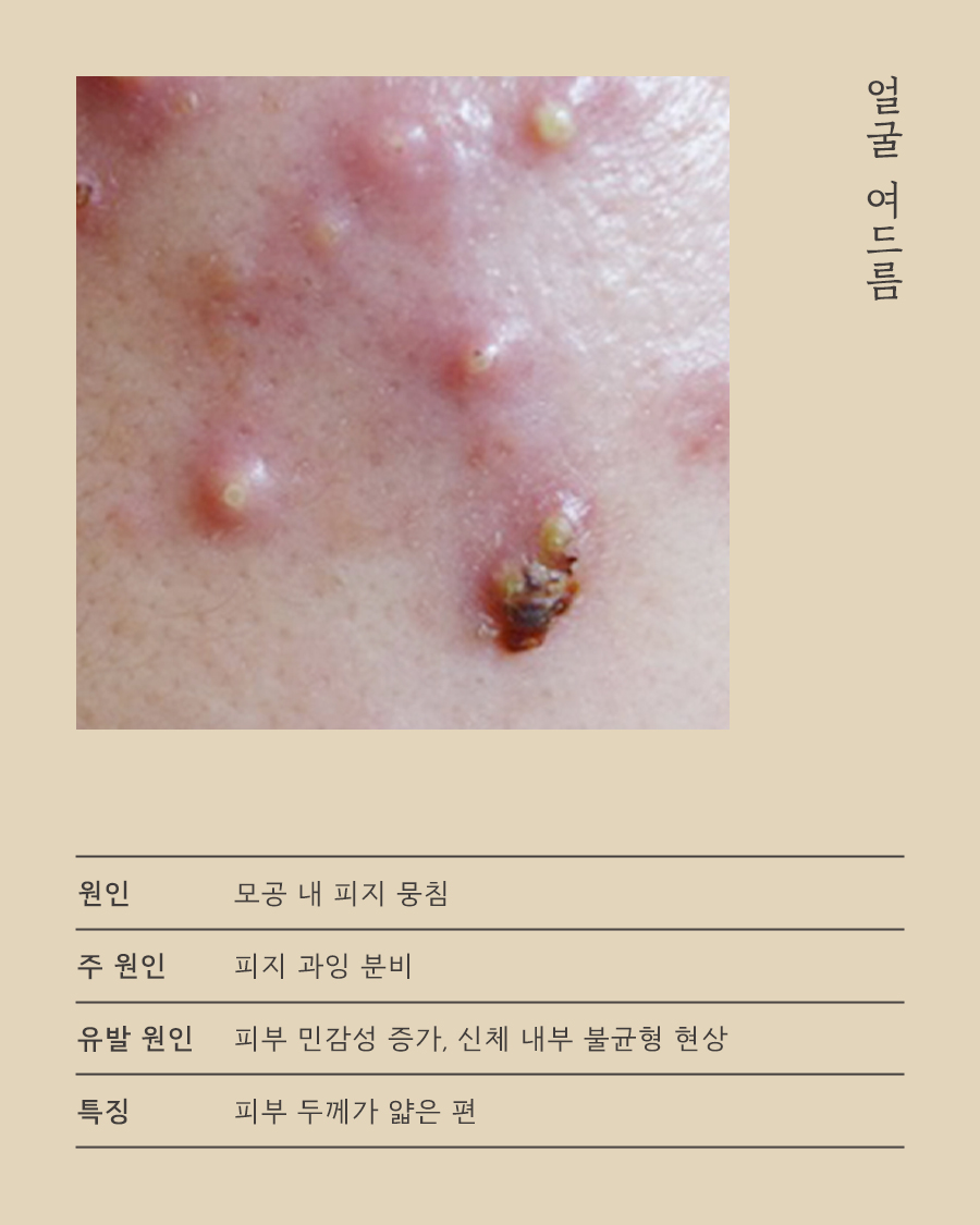 [분당점] 가슴여드름관리 미세약초침은 자국에 어떻게 활용하나요? 분당 해율한의원에서 설명드립니다 - 해율한의원