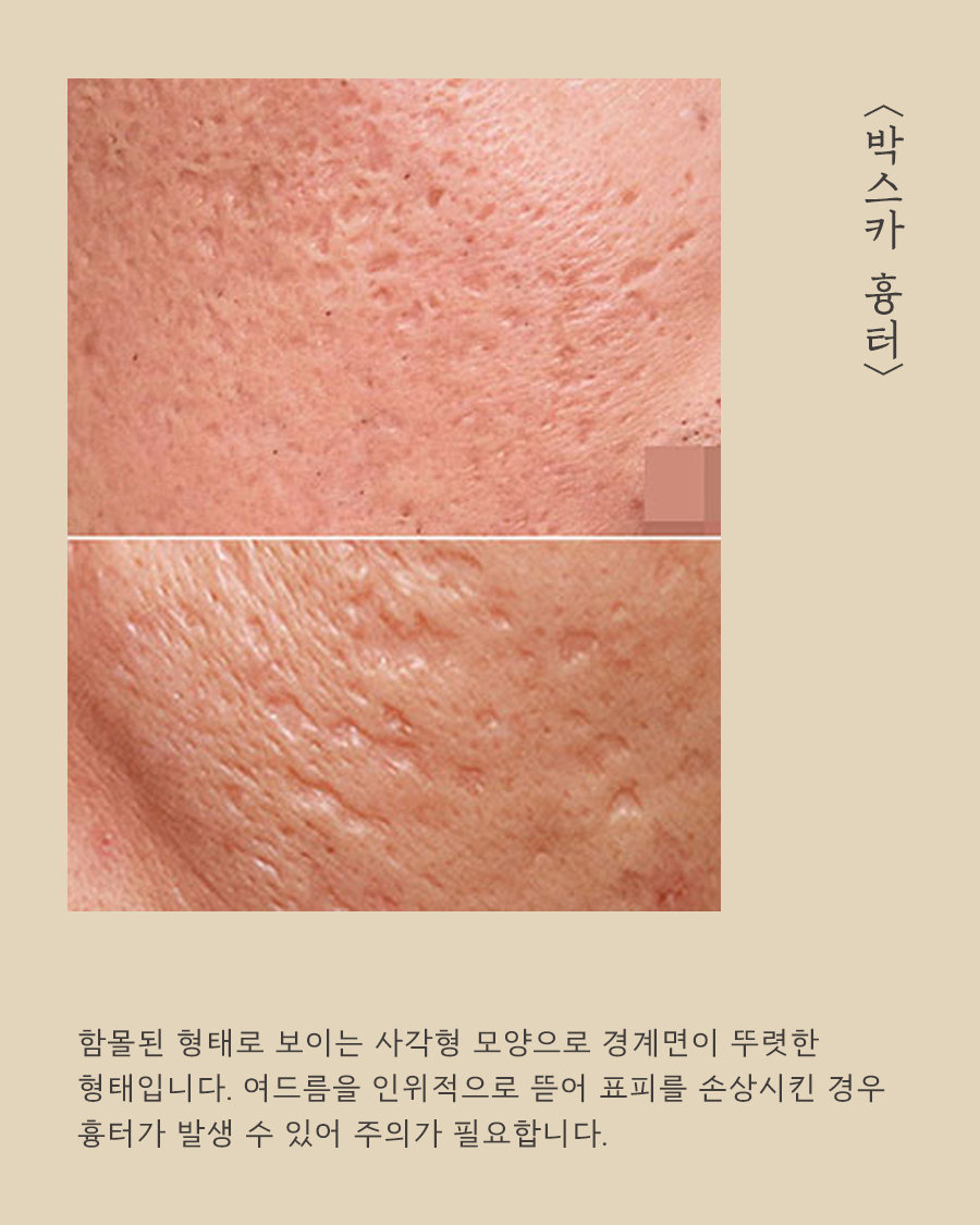 [천안점] 천안여드름흉터 vs 자국 차이점과 치료방법은? - 해율한의원