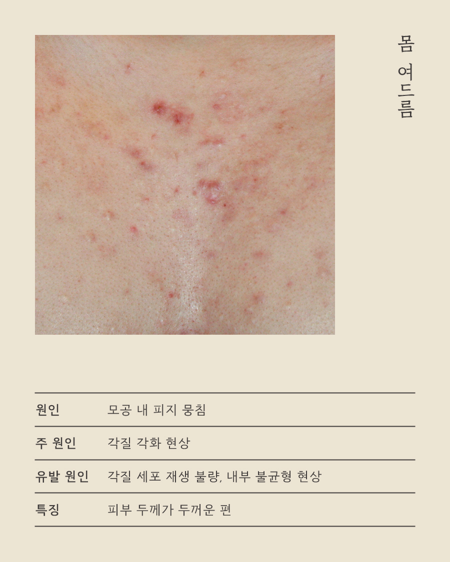[천안점] 가슴여드름 가드름 색소 침착, 자국 남는 이유는? 천안 해율한의원에서 설명드립니다 - 해율한의원