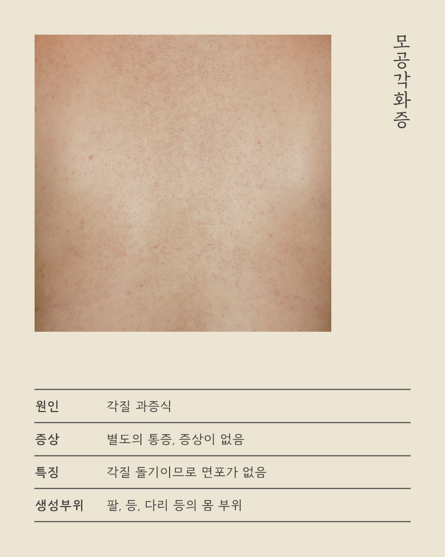 [목동점] 모공각화증 각질 제거로 사라지지 않는 이유, 목동 해율한의원이 설명드립니다 - 해율한의원