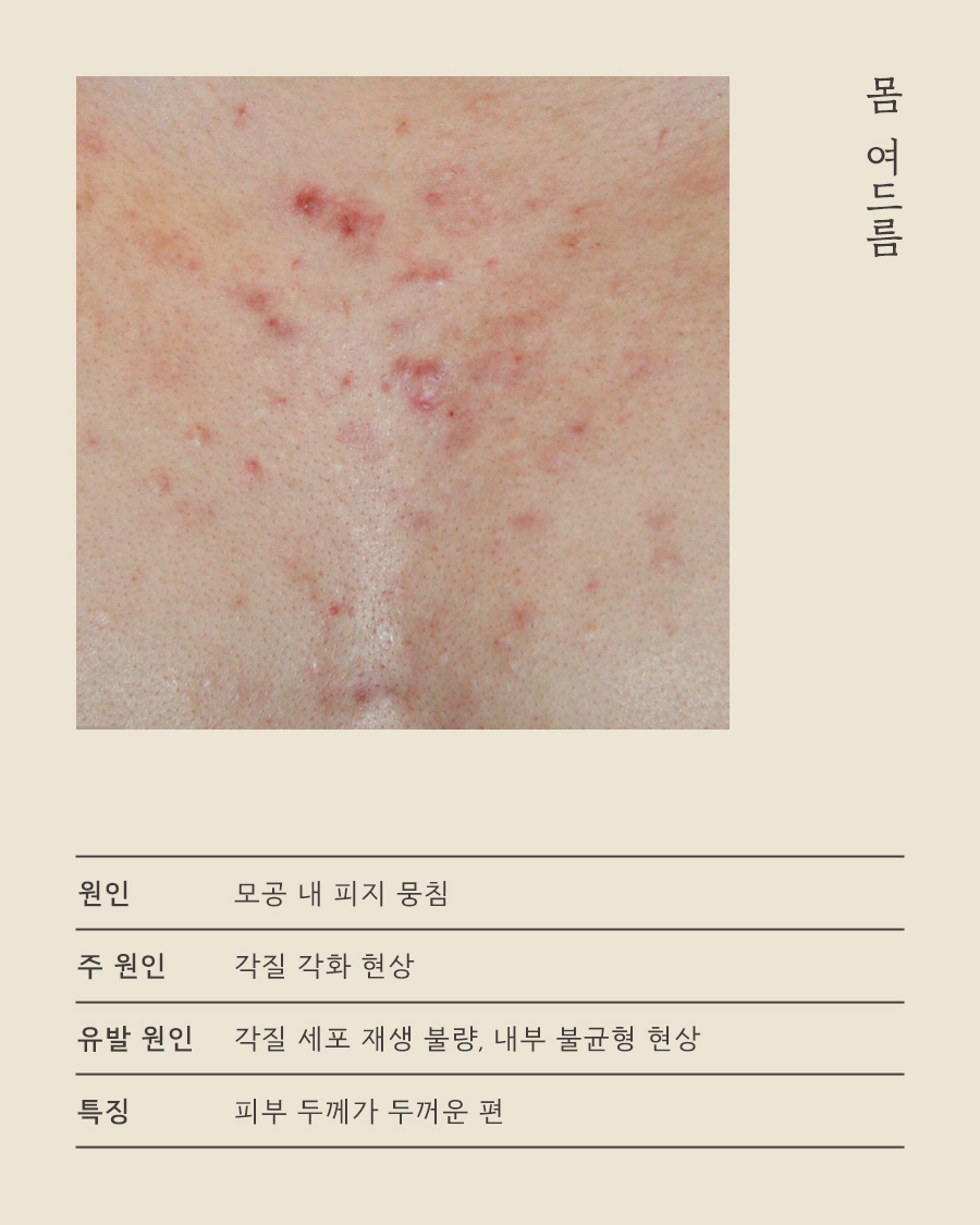 [분당점] 가슴여드름관리 미세약초침은 자국에 어떻게 활용하나요? 분당 해율한의원에서 설명드립니다 - 해율한의원