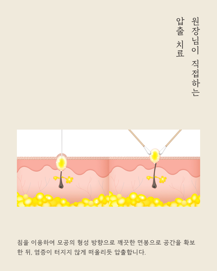 [울산점] 울산피부한의원 입 주변에만 생기는 트러블도 여드름인가요? - 해율한의원