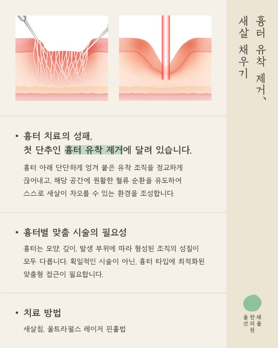 [울산점] 울산해율한의원 여드름흉터, 파인흉터 새살침과 레이저 병행치료법과 비용설명 드립니다. - 해율한의원
