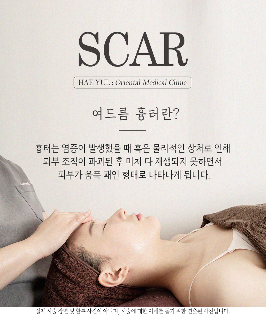 [안산점] 안산여드름흉터 오래된 흉터도 치료할 수 있나요? - 해율한의원