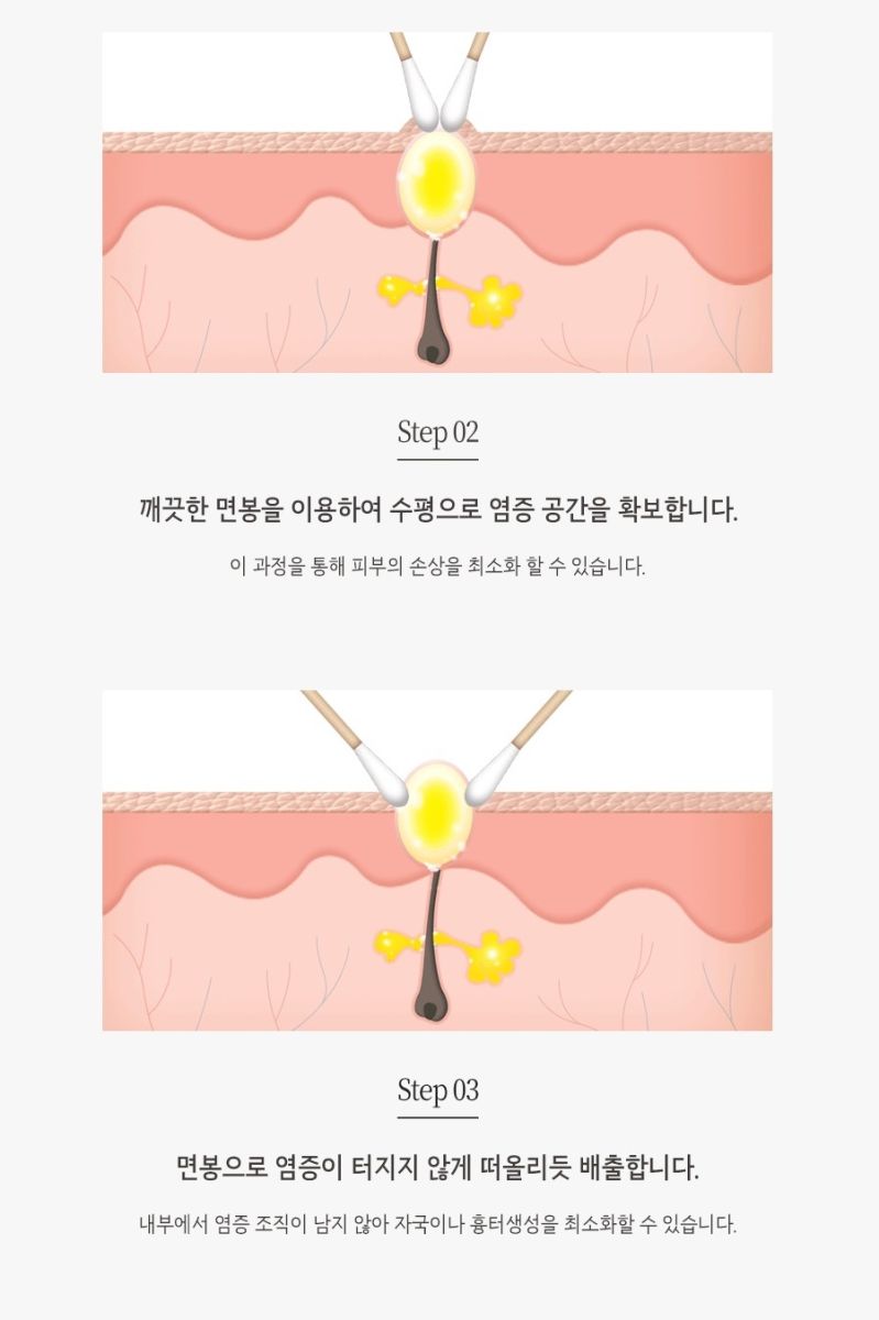 [안산점] 안산여드름한의원 압출 혼자서 하면 안되나요? - 해율한의원