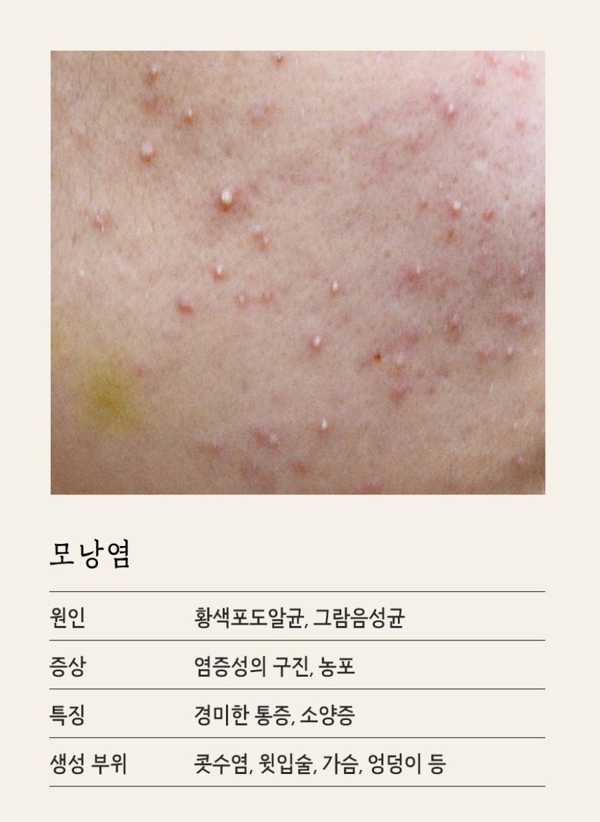 [수원점] 수원모낭염과 여드름은 어떻게 구별하나요? - 해율한의원