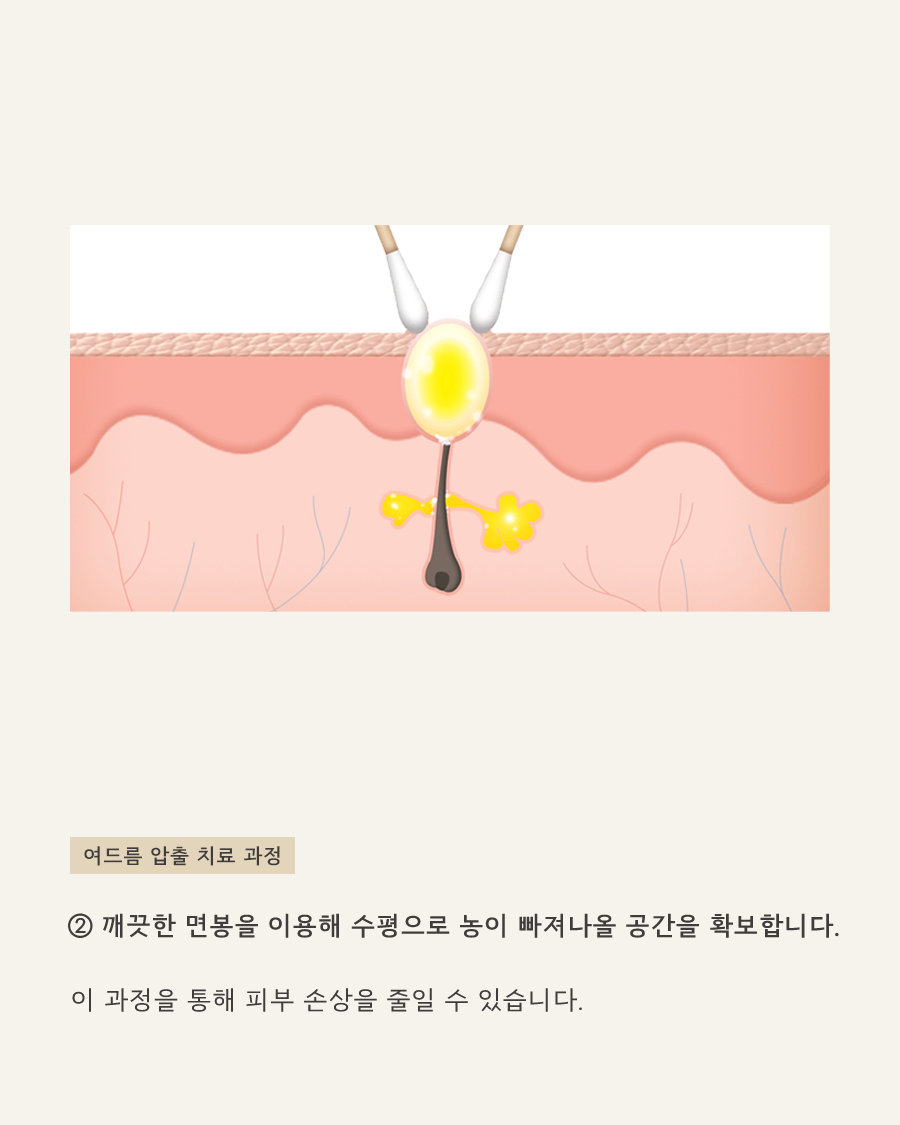 [목동점] 화곡여드름피부과 재발 막는 방법은 무엇일까요? - 해율한의원