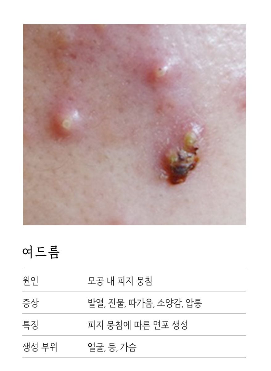[분당점] 분당모낭염 압출하면 안되는 이유, 원장님이 설명드립니다 - 해율한의원