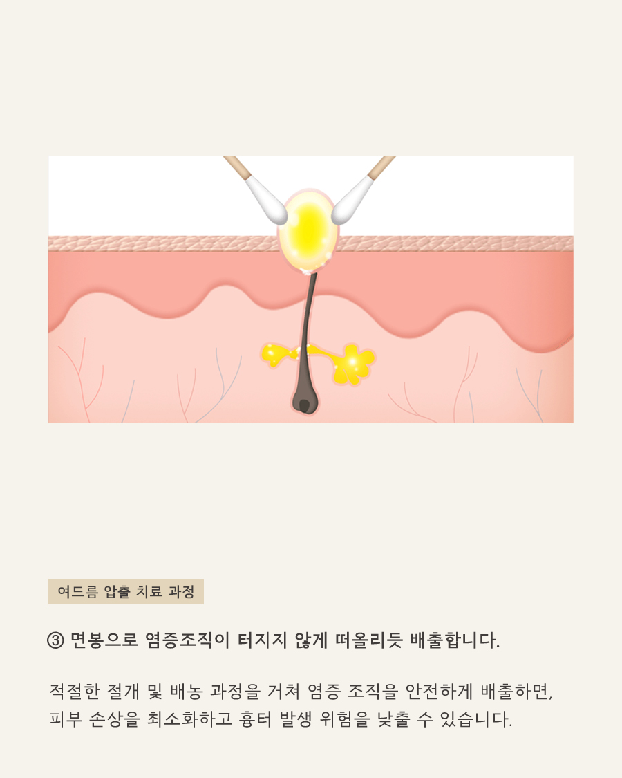 [목동점] 화곡여드름피부과 재발 막는 방법은 무엇일까요? - 해율한의원