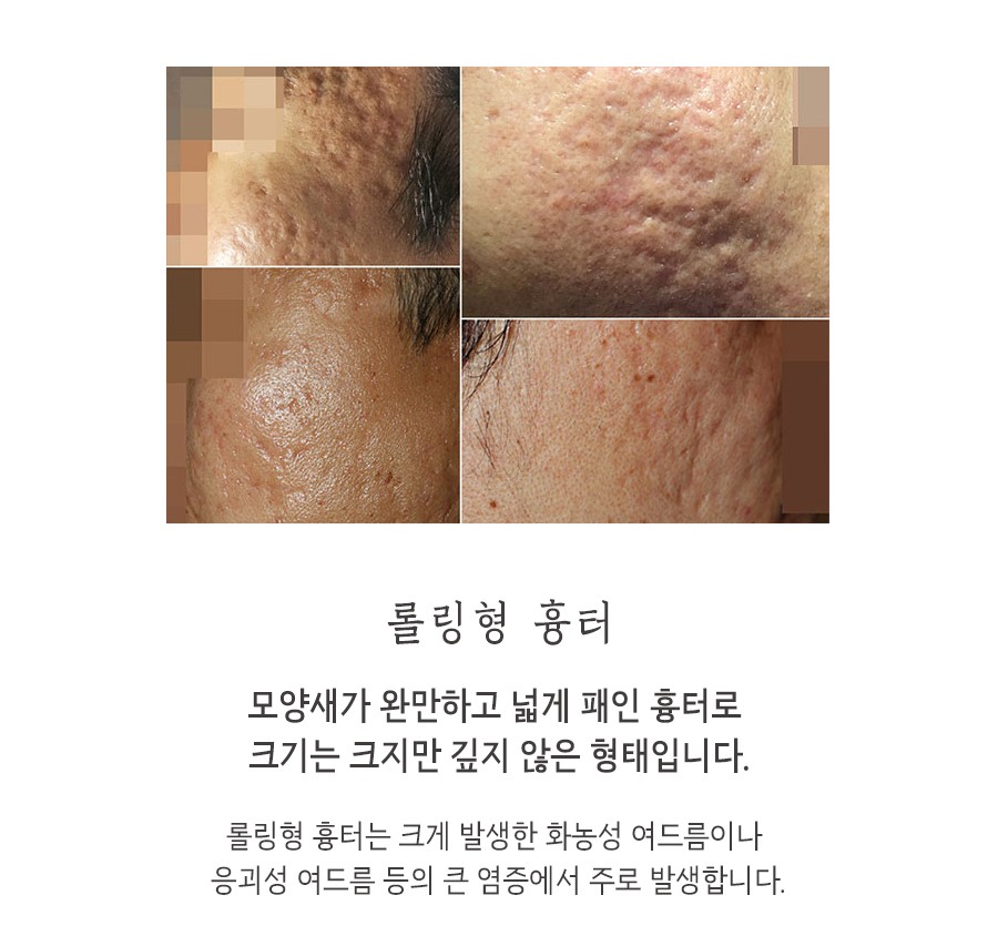 [인천점] 인천새살침 흉터 모양에 따라 치료방법도 달라지나요? - 해율한의원