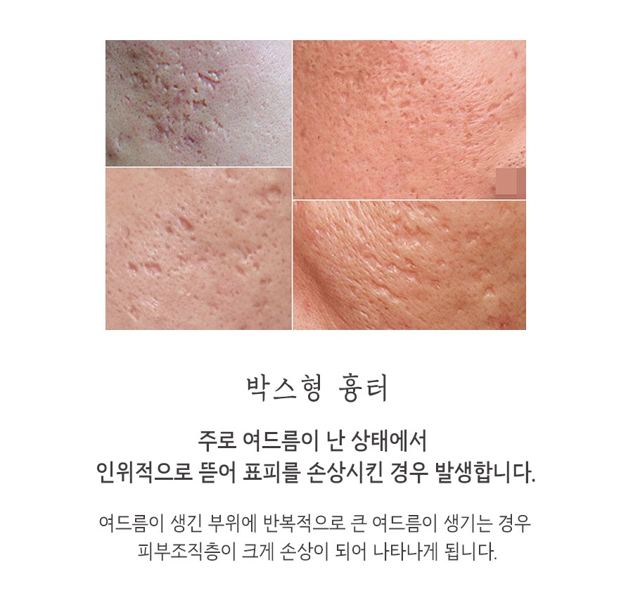 [인천점] 인천새살침 흉터 모양에 따라 치료방법도 달라지나요? - 해율한의원