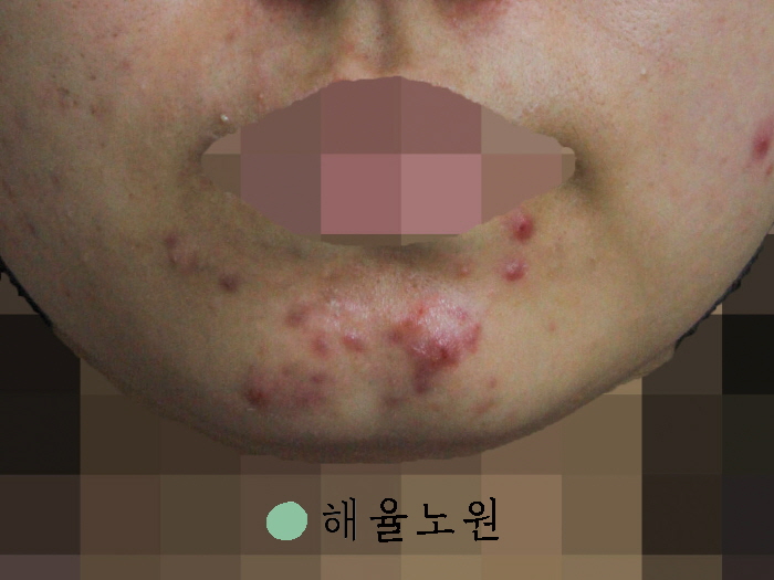 [노원점] 모낭염 재발 원인, 치료에 대해 노원 해율한의원에서 설명드립니다 - 해율한의원