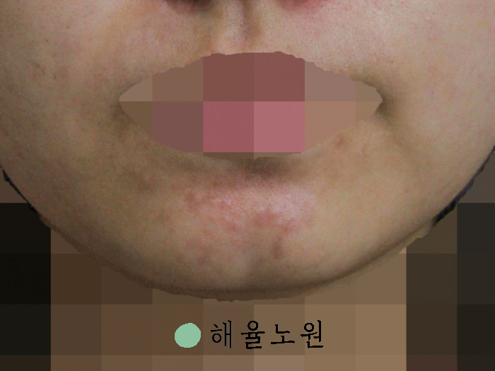 [노원점] 모낭염 재발 원인, 치료에 대해 노원 해율한의원에서 설명드립니다 - 해율한의원