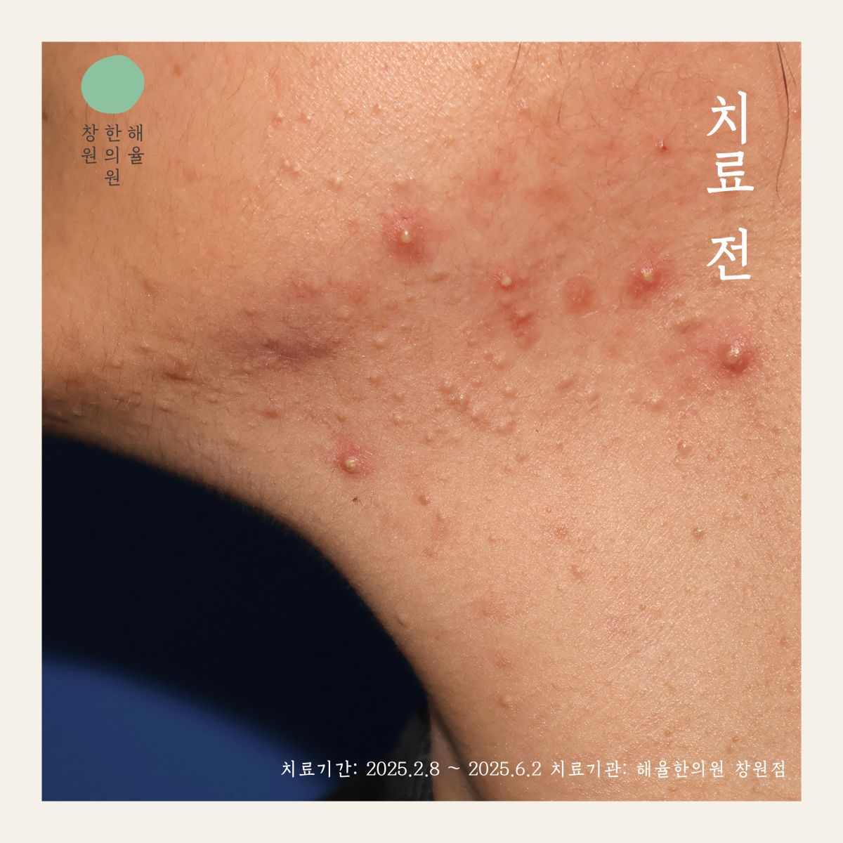 [창원점] 창원여드름치료 압출 꼭 해야 하나요? 원장님이 설명드립니다 - 해율한의원