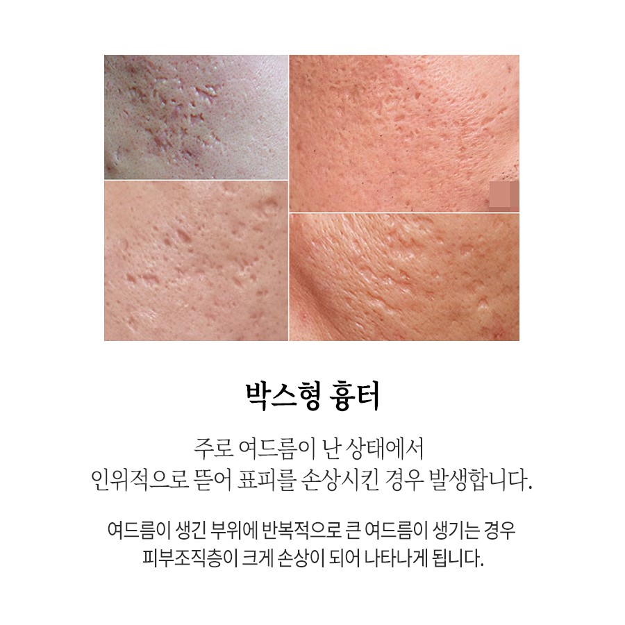 [홍대점] 홍대여드름흉터 오래된 경우에도 치료  가능한가요? - 해율한의원