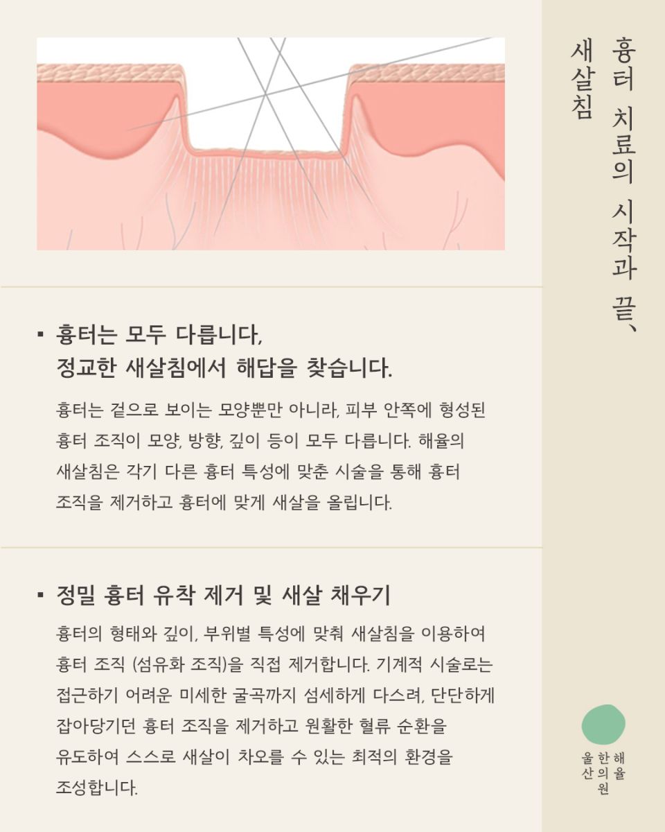 [울산점] 울산해율한의원 여드름흉터, 파인흉터 새살침과 레이저 병행치료법과 비용설명 드립니다. - 해율한의원