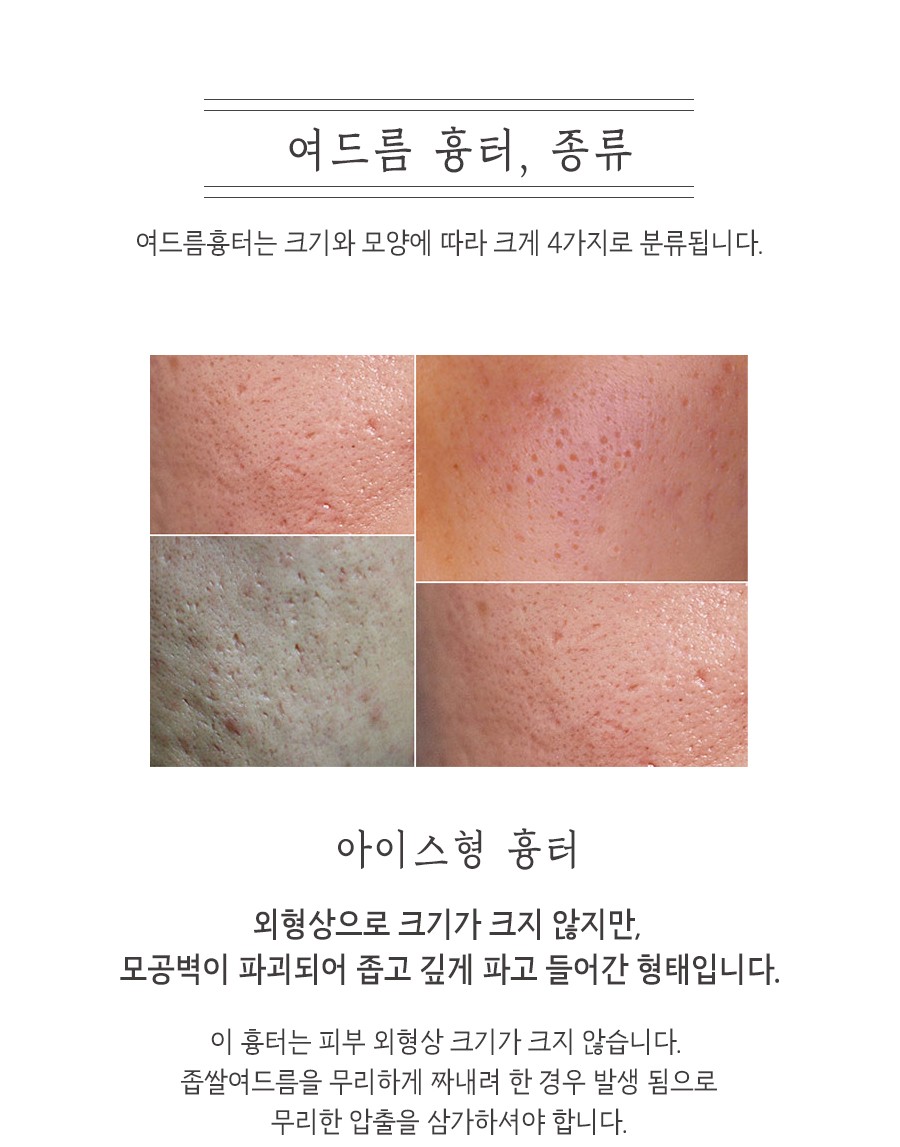 [안산점] 안산여드름흉터 오래된 흉터도 치료할 수 있나요? - 해율한의원