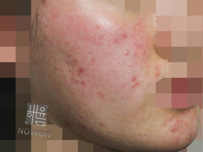 [분당점] 지루성피부염 붉고 가려운 이유, 치료까지 분당 해율한의원이 설명드립니다 - 해율한의원