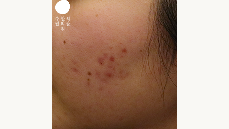 [수원점] 수원여드름자국 미세약초침 치료 후 주의해야 하는 부분은? - 해율한의원