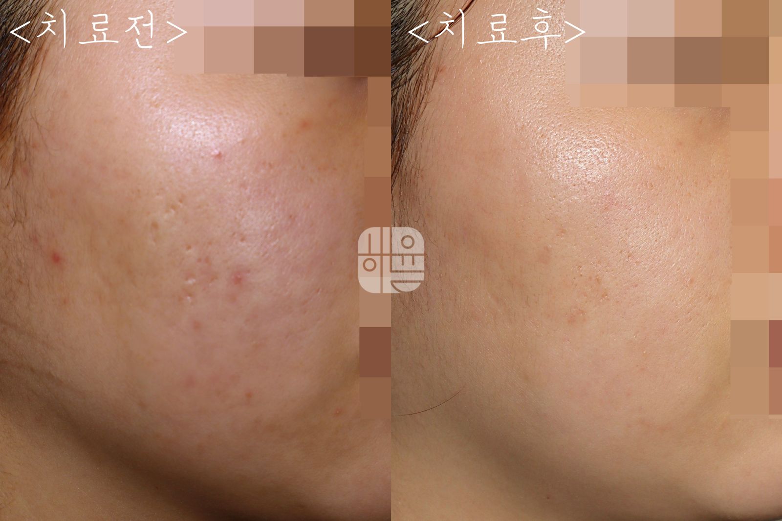 [광주점] 여드름흉터 시간 지나면 자연스럽게 없어질까요? 광주해율한의원에서 알려드립니다 - 해율한의원