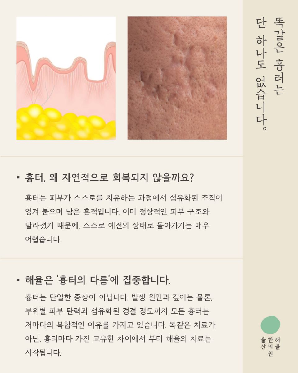 [울산점] 울산해율한의원 여드름흉터, 파인흉터 새살침과 레이저 병행치료법과 비용설명 드립니다. - 해율한의원