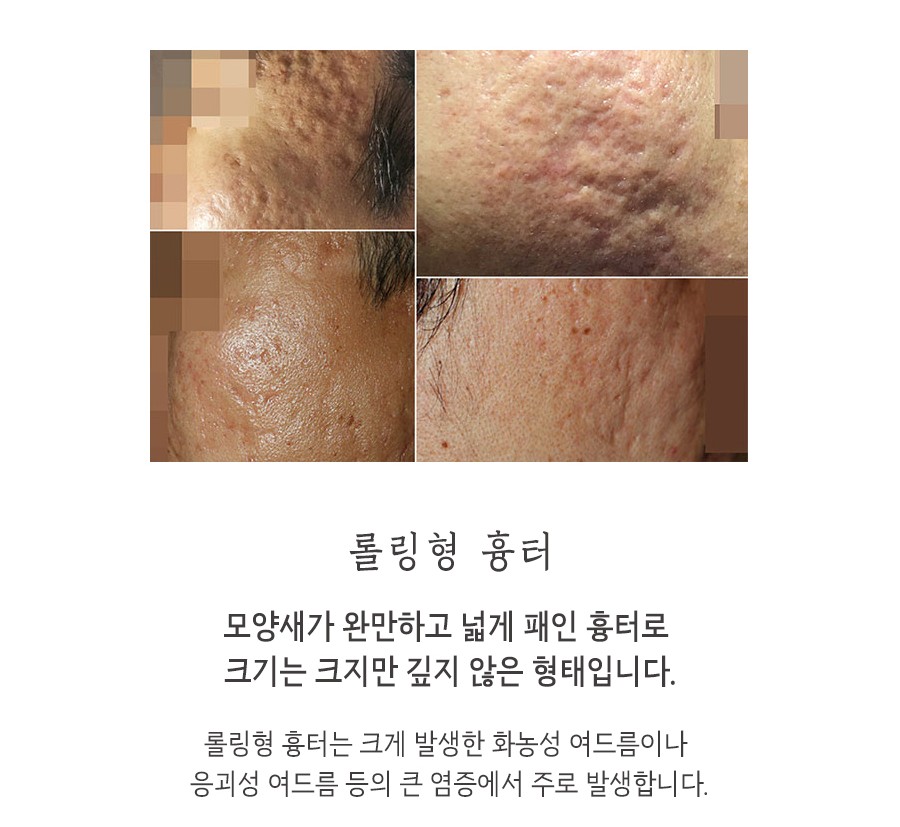[안산점] 안산여드름흉터 오래된 흉터도 치료할 수 있나요? - 해율한의원