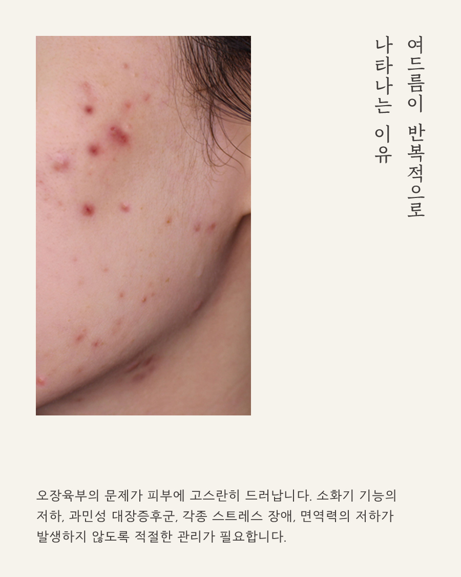 [목동점] 화곡여드름피부과 재발 막는 방법은 무엇일까요? - 해율한의원