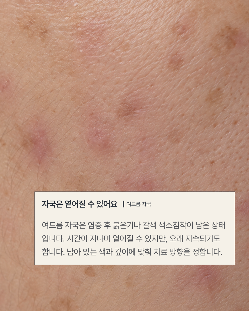 [수원점] 여드름 자국과 흉터 어떻게 구분할까요? - 해율한의원