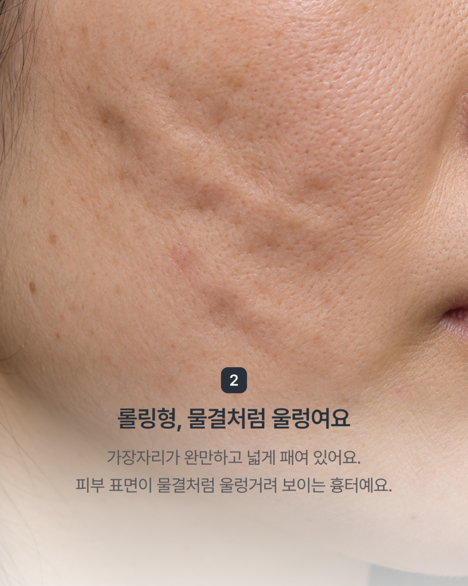 [강남점] 패인 여드름 흉터, 모양에 따라 치료 방향이 달라져요 - 해율한의원