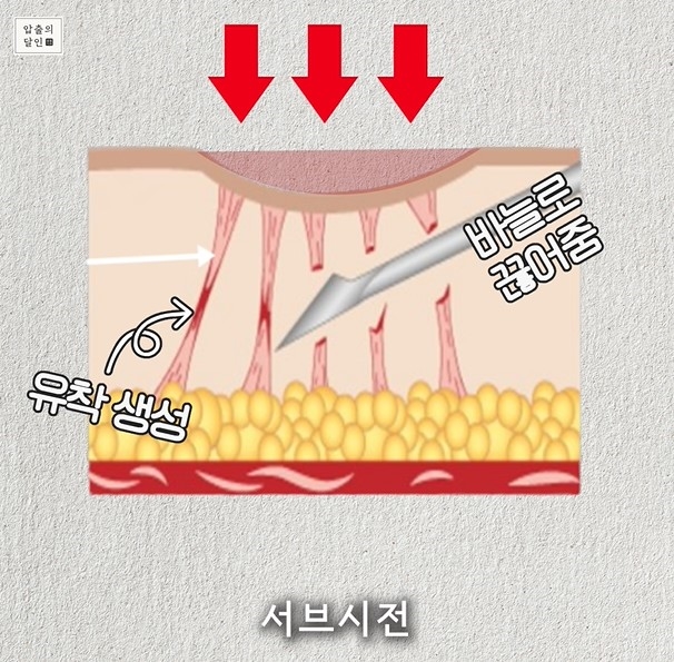 [대구점] 대구여드름흉터 새살침과 서브시전 치료 방법 - 해율한의원