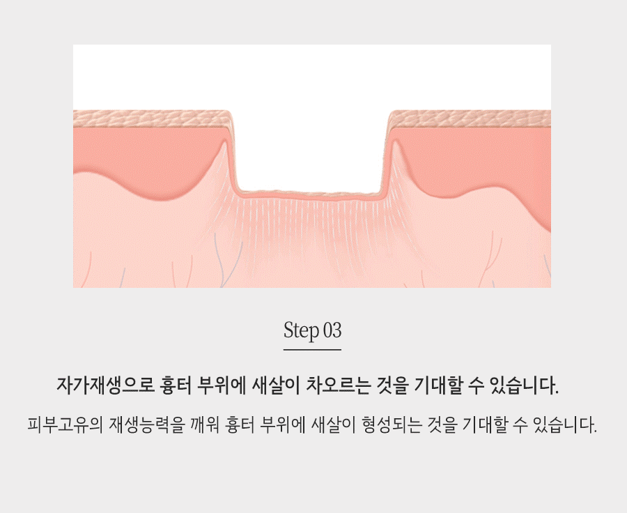 [창원점] 창원여드름흉터 오래된 것도 치료할 수 있을까요? - 해율한의원