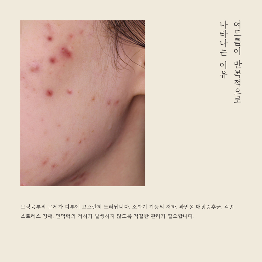 [안양점] 안양여드름한의원 피부 상태에 따라 치료 방법이 달라지나요? - 해율한의원