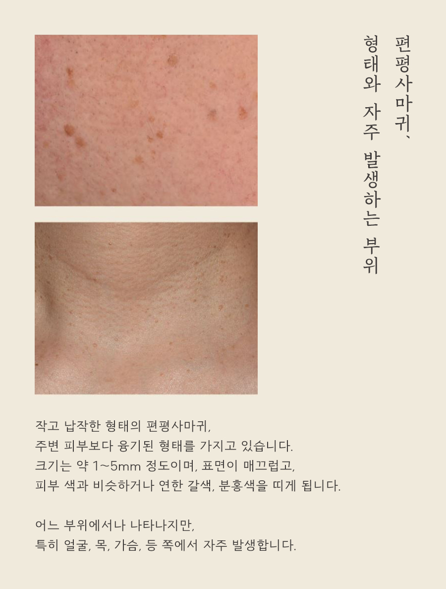 [인천점] 인천편평사마귀 제거 언제 치료하는게 좋을까요? - 해율한의원