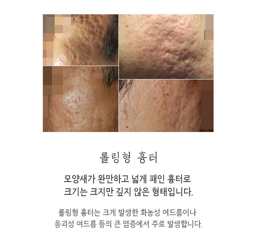 [홍대점] 홍대여드름흉터 어떤 방법으로 치료하나요? - 해율한의원