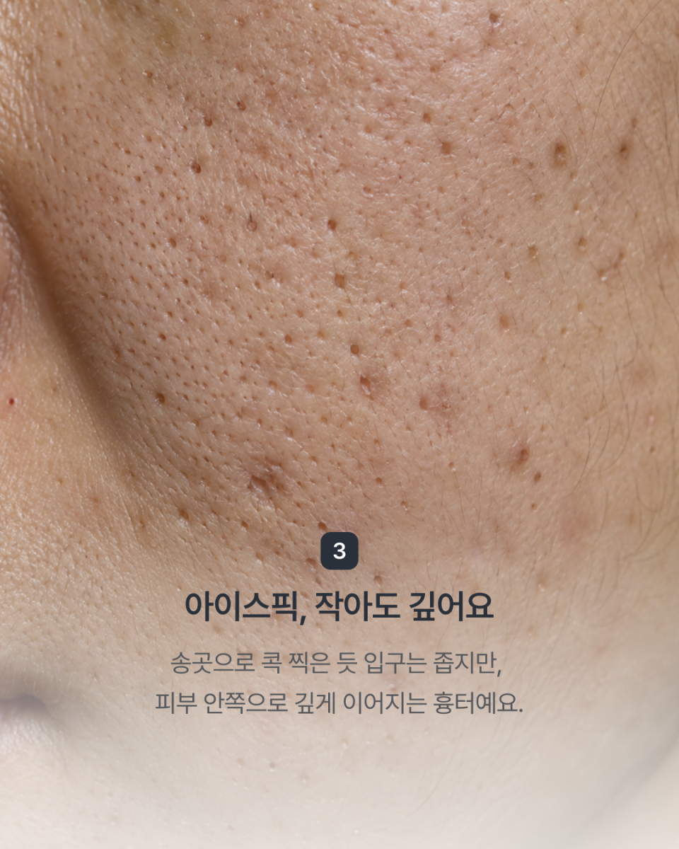 [강남점] 패인 여드름 흉터, 모양에 따라 치료 방향이 달라져요 - 해율한의원