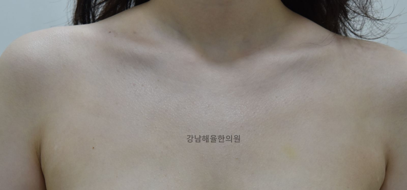 [강남점] 강남가슴여드름 생기는 순간부터 달라져야 할 관리법 - 해율한의원