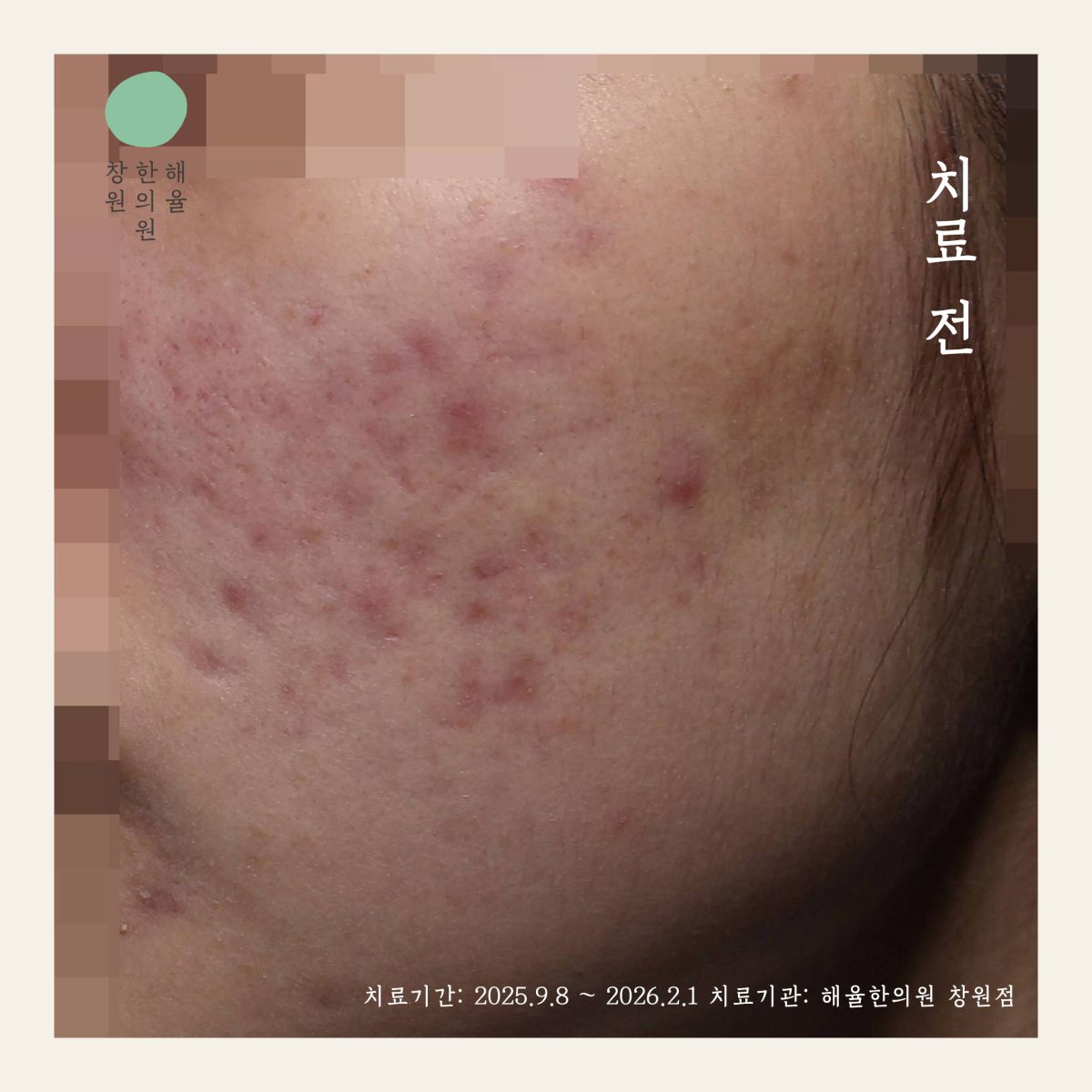 [창원점] 창원여드름흉터 오래된 것도 치료할 수 있을까요? - 해율한의원