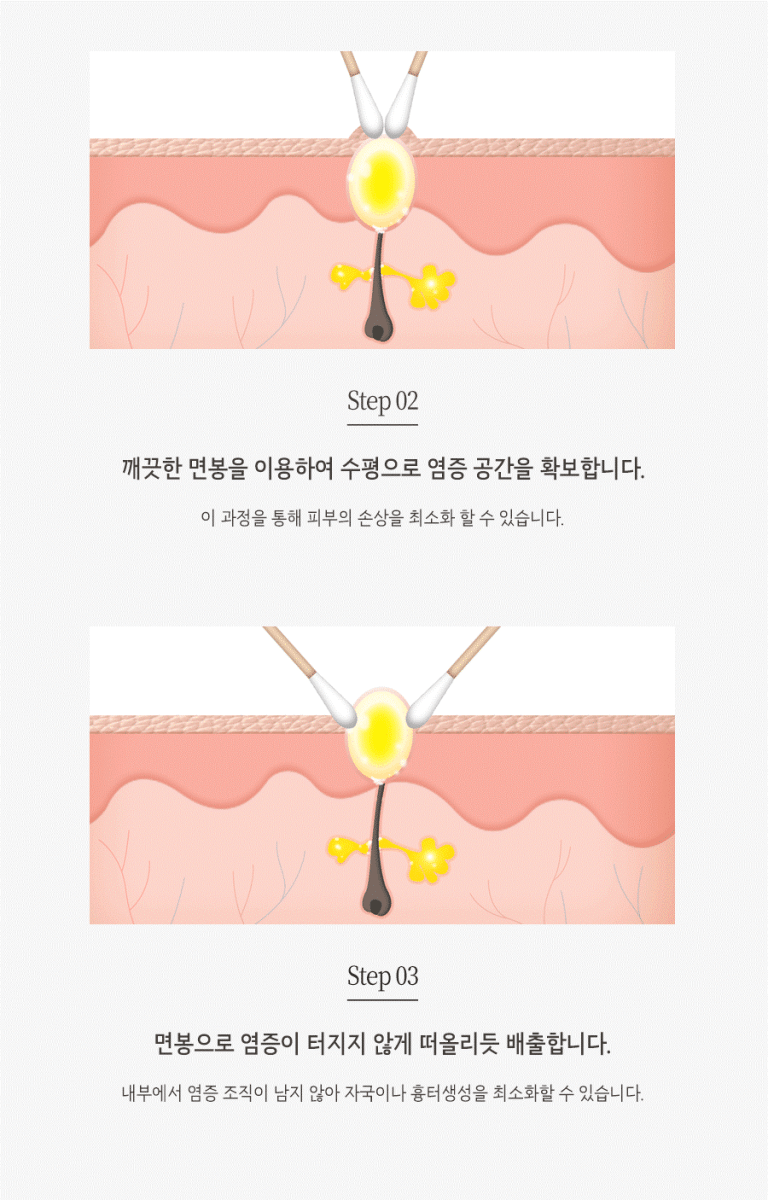 [울산점] 울산청소년어린이여드름 치료법과 비용 해율한의원이 설명드립니다. - 해율한의원