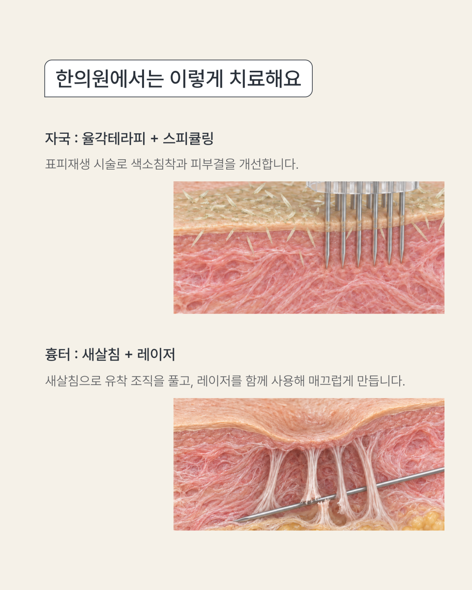[수원점] 여드름 자국과 흉터 어떻게 구분할까요? - 해율한의원