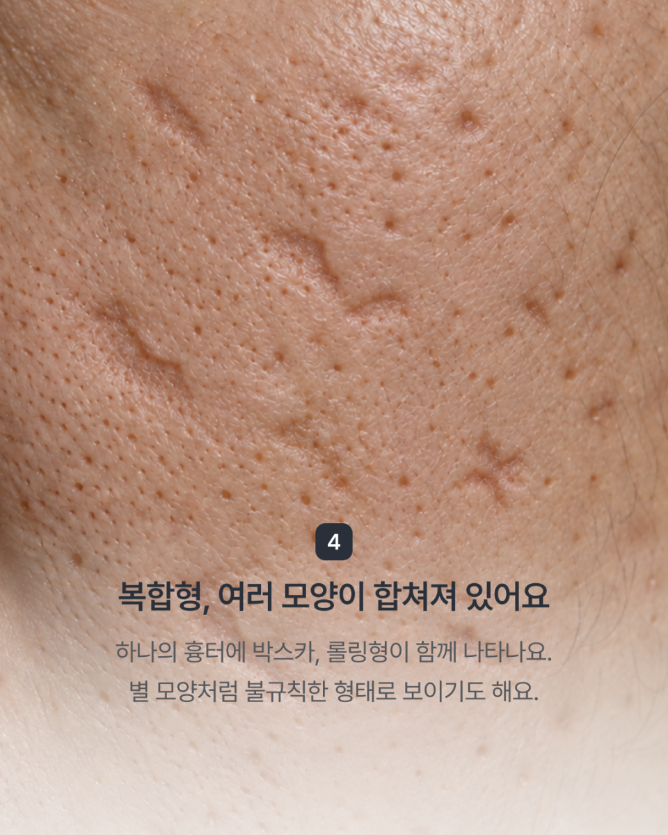 [강남점] 패인 여드름 흉터, 모양에 따라 치료 방향이 달라져요 - 해율한의원