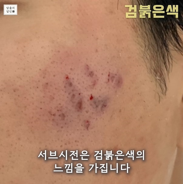 [대구점] 대구여드름흉터 새살침과 서브시전 치료 방법 - 해율한의원