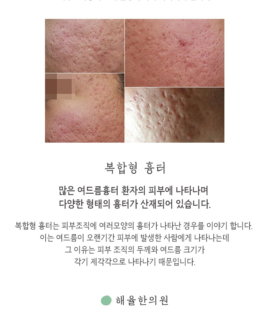[홍대점] 홍대여드름흉터 어떤 방법으로 치료하나요? - 해율한의원