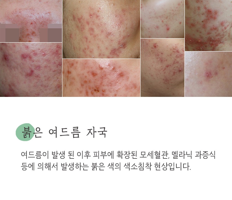 [천안점] 천안여드름자국 미세약초침 원리 및 효과에 대해 설명드립니다 - 해율한의원