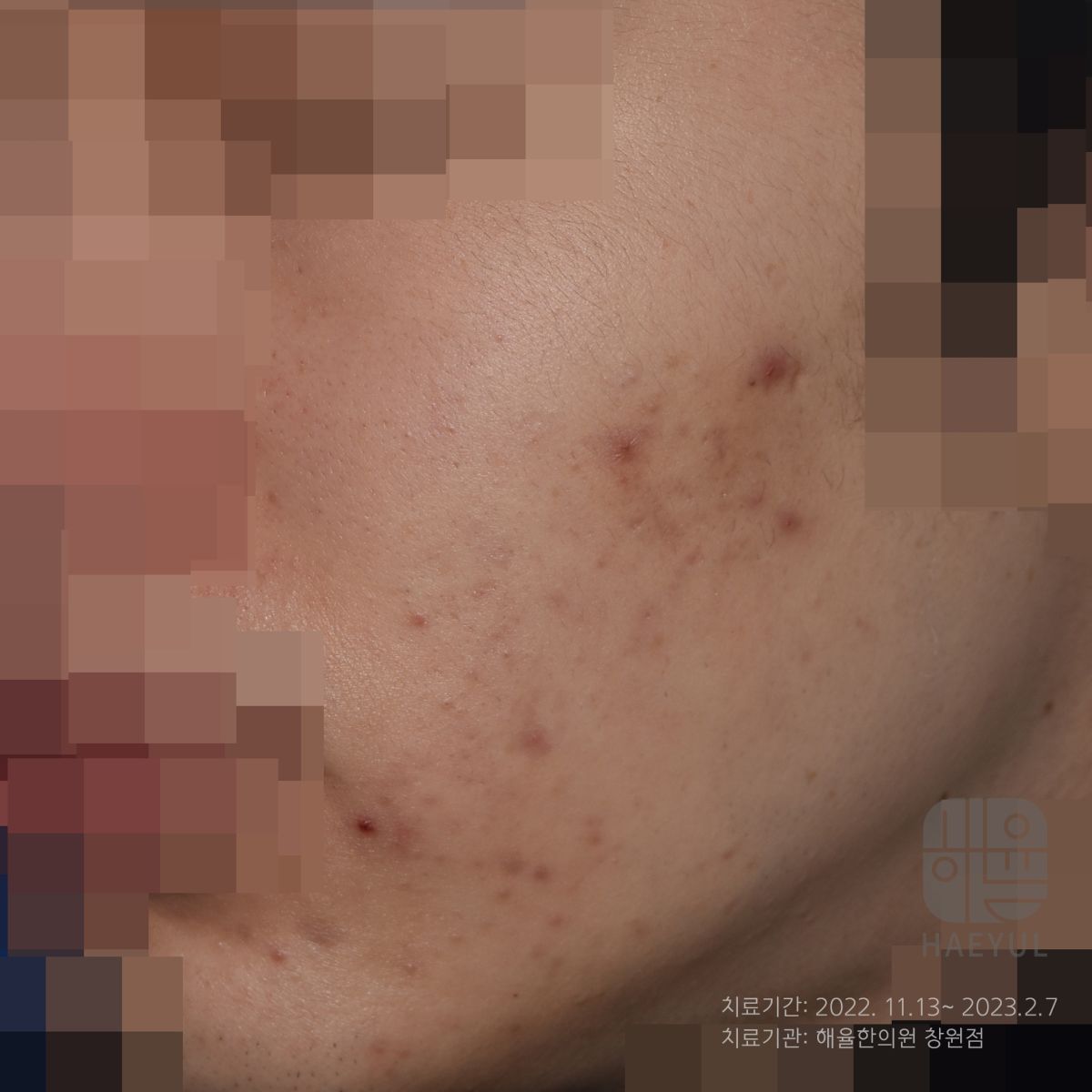 [창원점] 여드름자국 미세약초침 시술 필요한 이유 창원해율한의원과 알아봐요 - 해율한의원