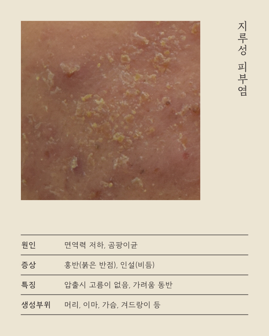 [목동점] 지루성여드름 근본적으로 치료하기 위한 한방 치료 - 해율한의원