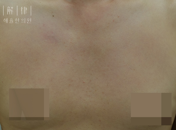 [수원점] 수원가슴여드름 관리할 때 흔히 하는 실수는? - 해율한의원