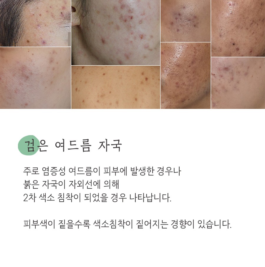 [천안점] 천안여드름자국 미세약초침 원리 및 효과에 대해 설명드립니다 - 해율한의원