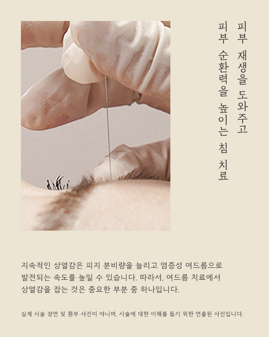 [목동점] 여드름, 어떻게 관리해야 할까요? - 해율한의원