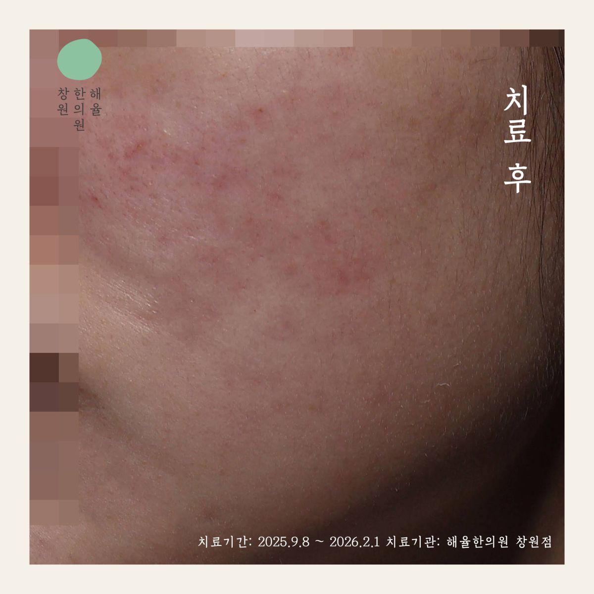 [창원점] 창원여드름흉터 오래된 것도 치료할 수 있을까요? - 해율한의원